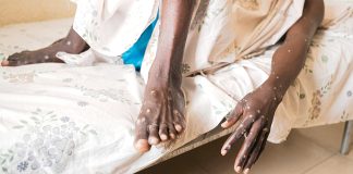 Mpox en Afrique – Près d’un million de doses de vaccin attendues
