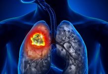 Mascara – Plus de 4000 cas de cancer du poumon chaque année en Algérie