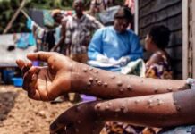 Madagascar – Le nombre de cas confirmés de Mpox dépasse les 3.000